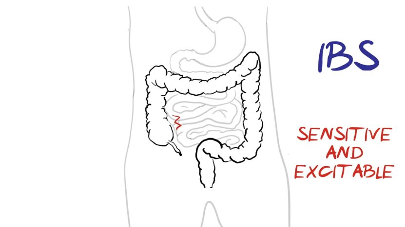 What is IBS